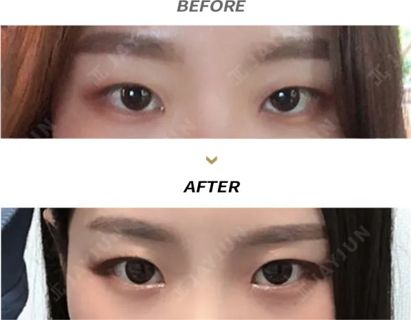 Before/After