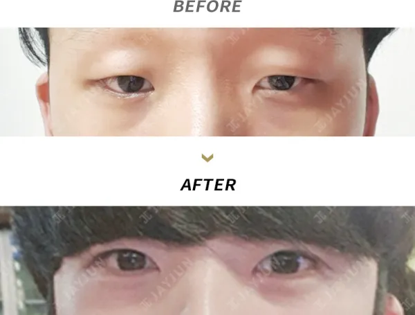 Before/After