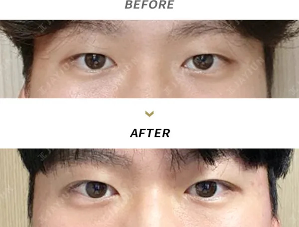 Before/After
