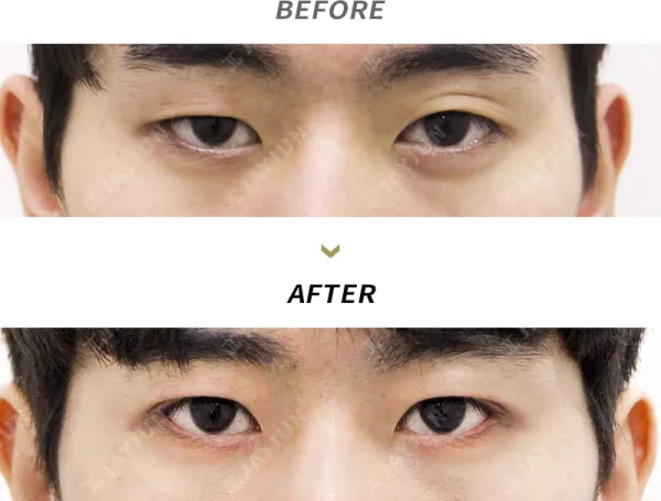 Before/After