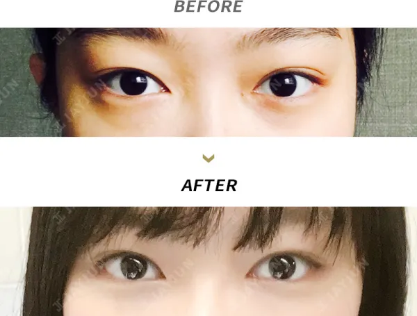 Before/After