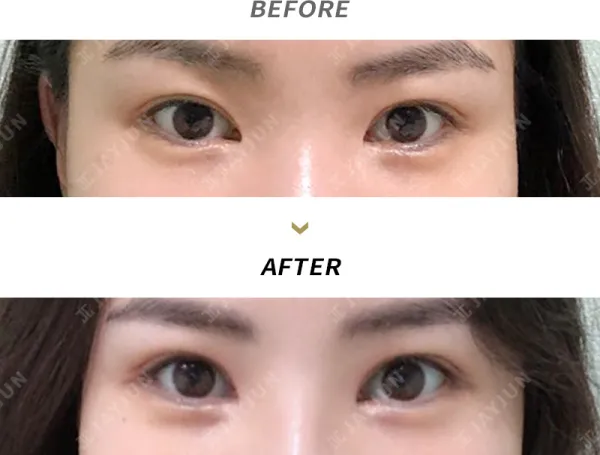 Before/After