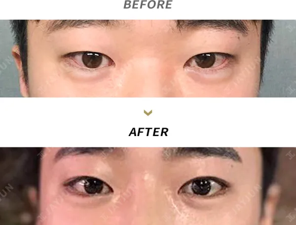 Before/After