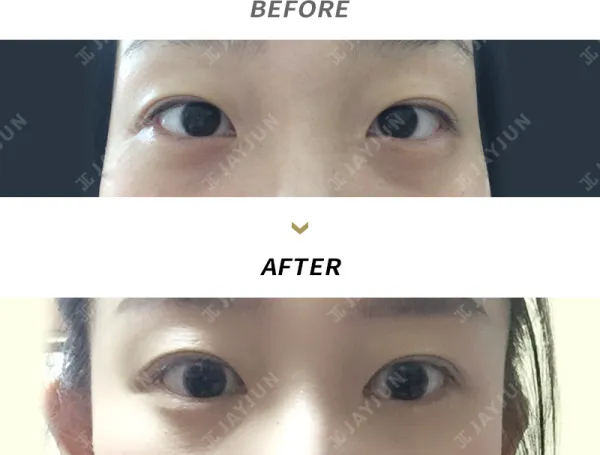 Before/After