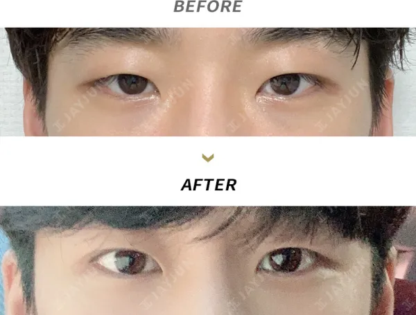 Before/After