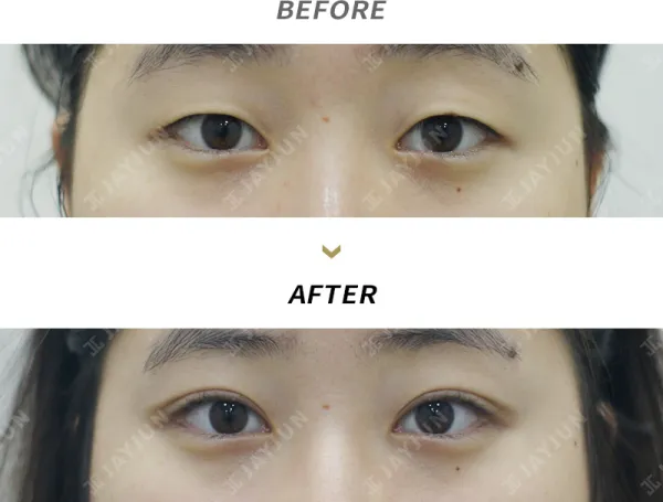 Before/After