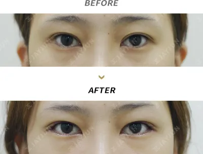 Before & After