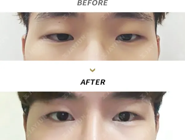 Before/After