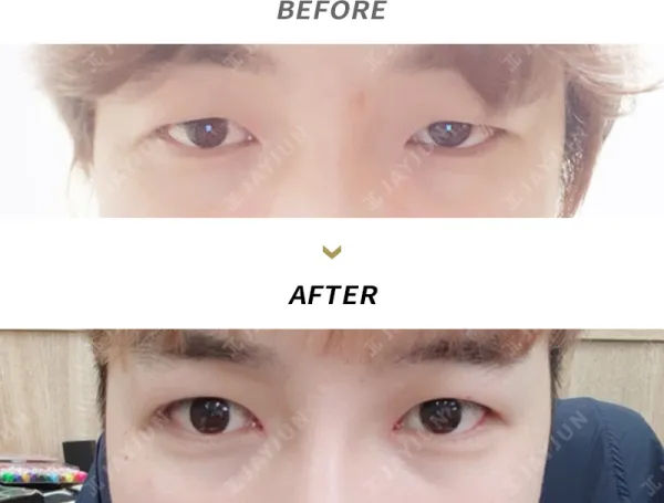 Before/After