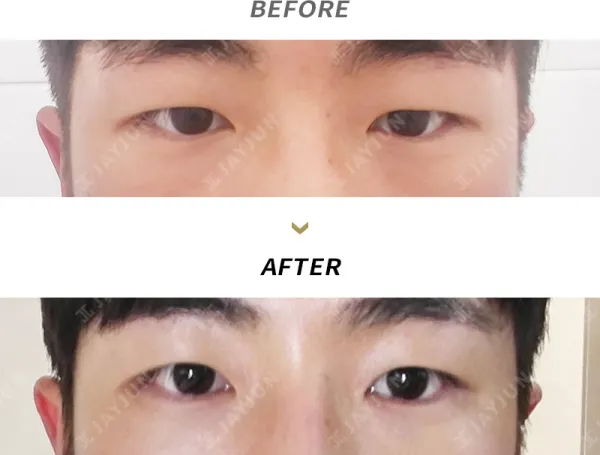 Before/After