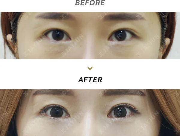 Before/After