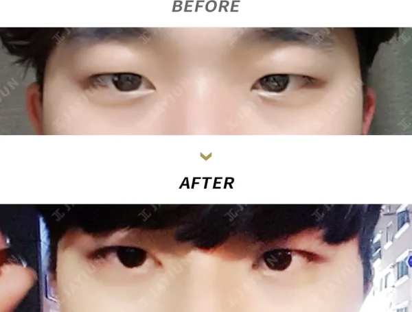 Before/After