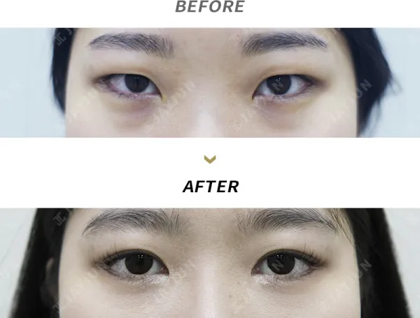 Before/After