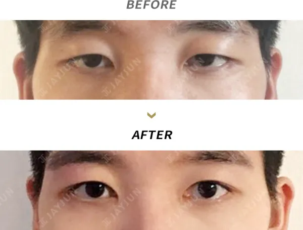Before/After