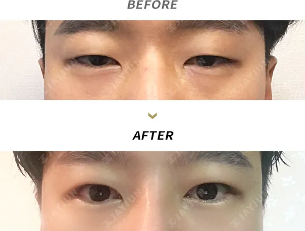 Before/After