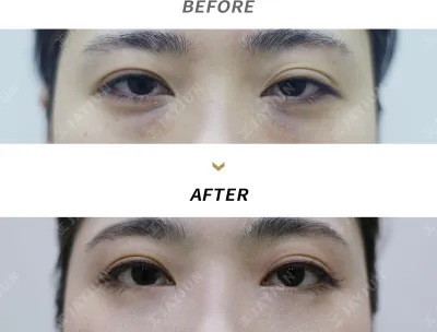 Before & After