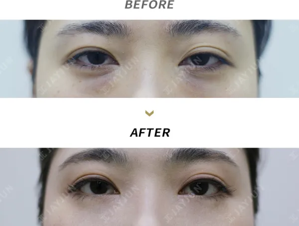 Before/After