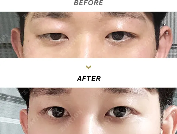 Before/After