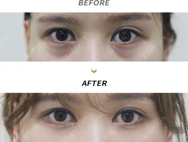 Before/After