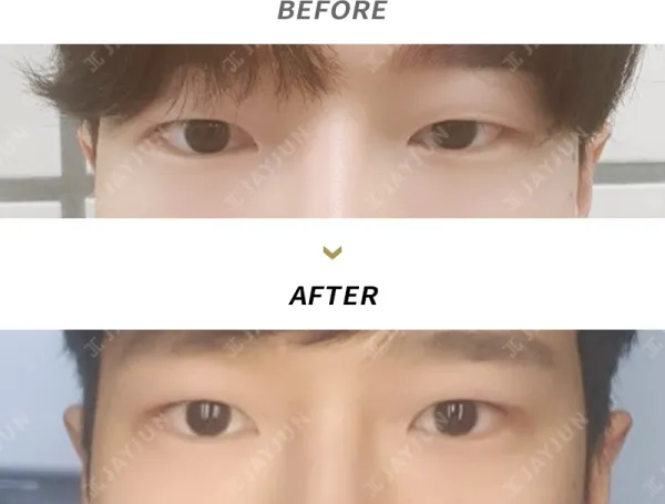 Before/After
