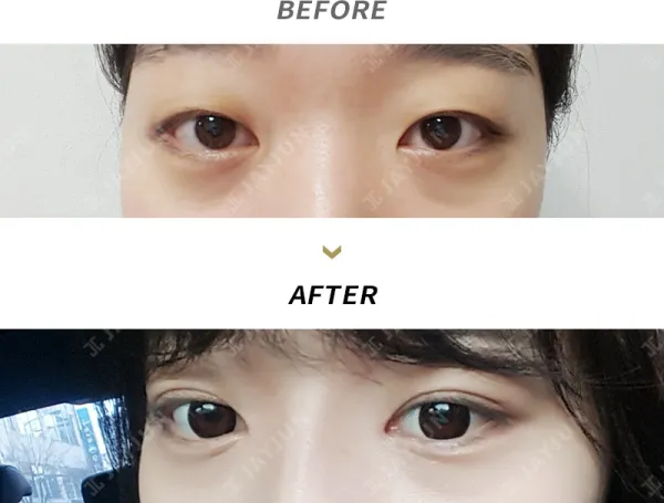 Before/After