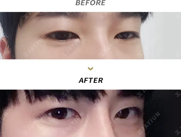 Before/After