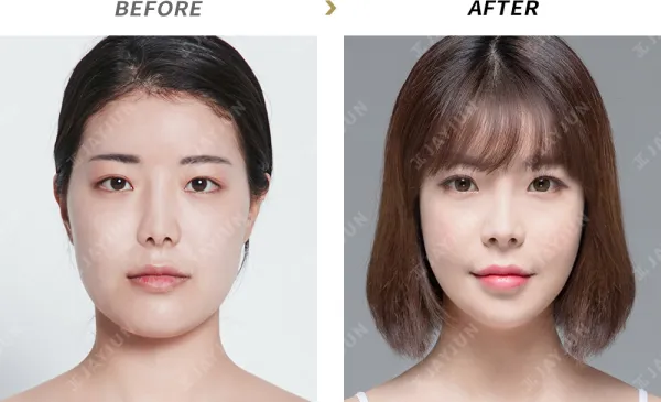 Before/After