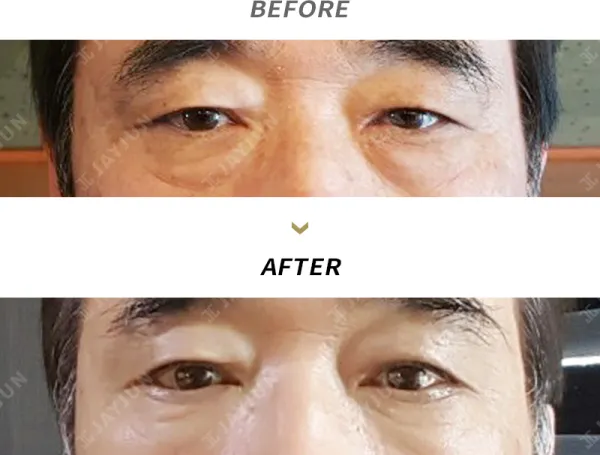 Before/After