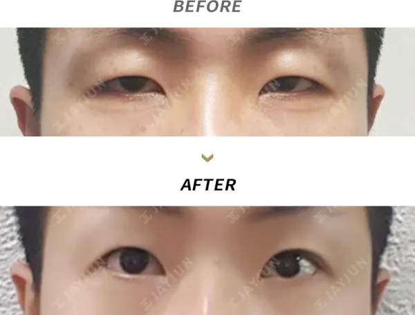 Before/After