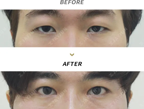 Before/After