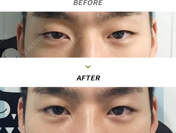Before/After