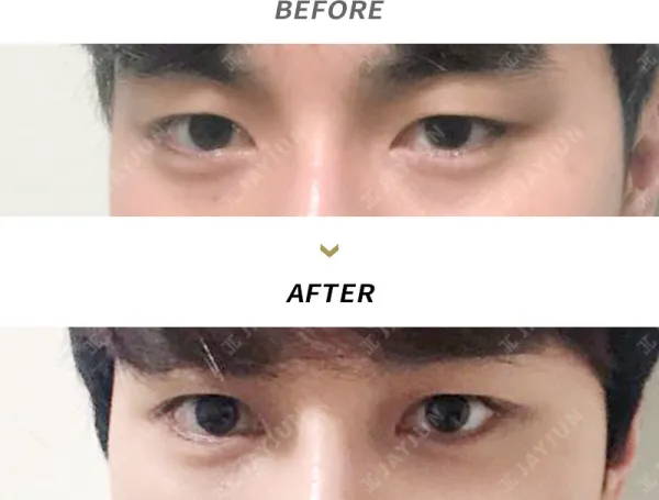 Before/After