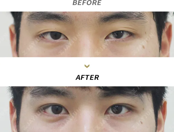 Before/After