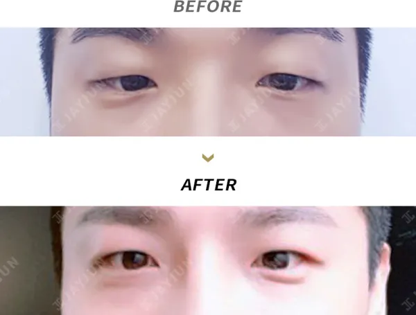 Before/After
