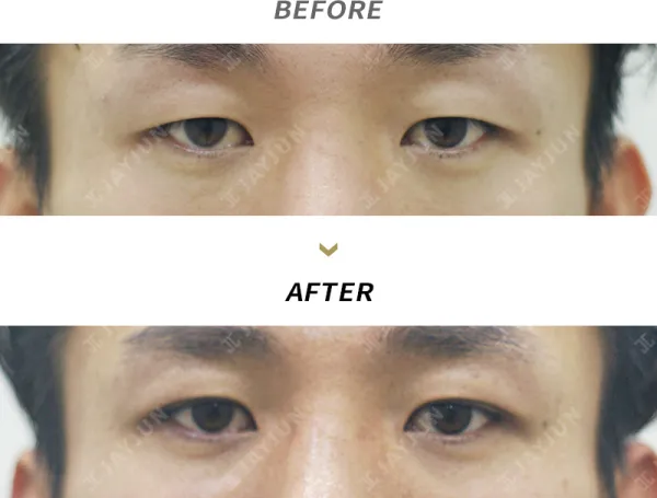 Before/After