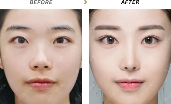 Before/After