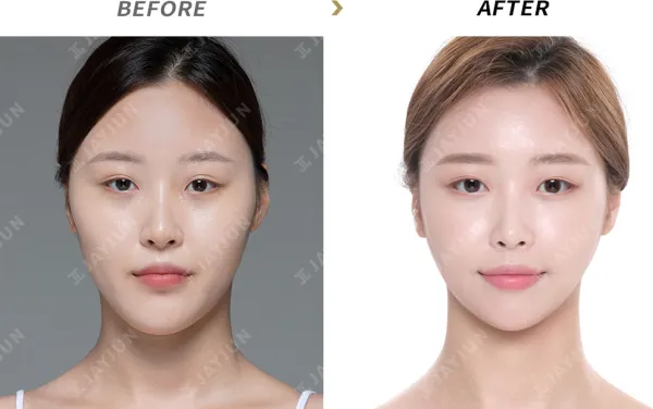 Before/After
