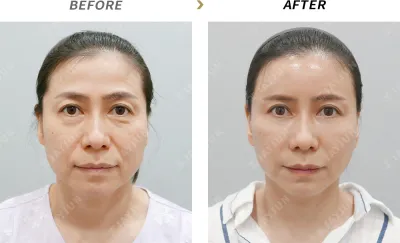Before & After
