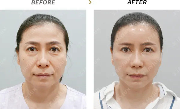 Before/After