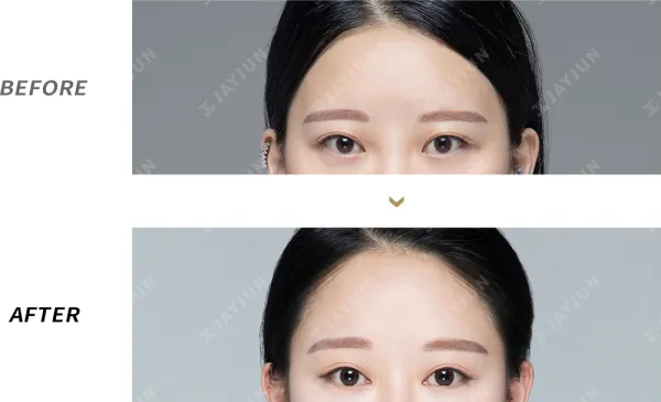 Before/After