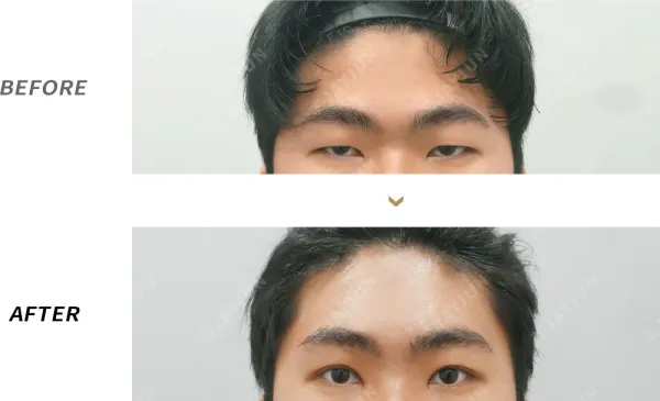 Before/After