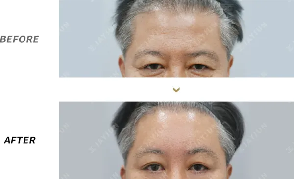 Before/After
