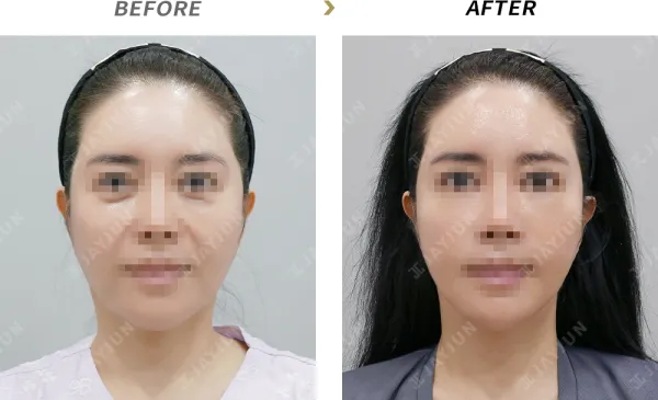 Before/After