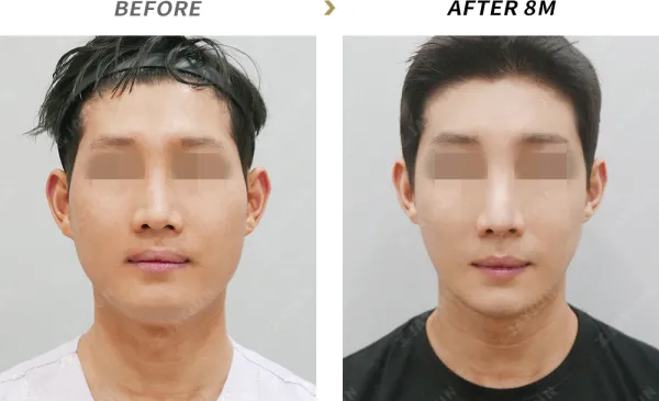 Before/After