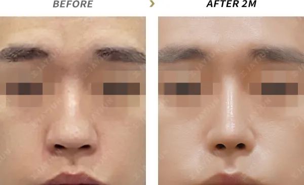 Before/After