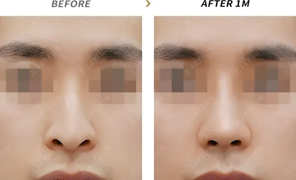 Before/After