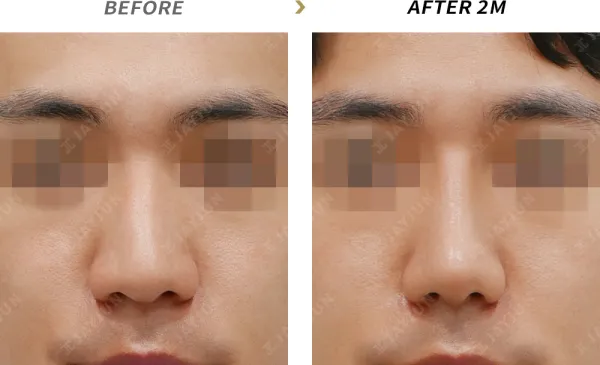Before/After