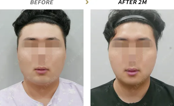 Before/After