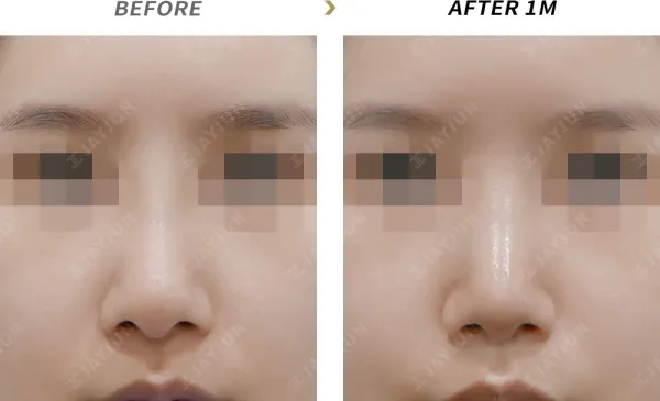 Before/After