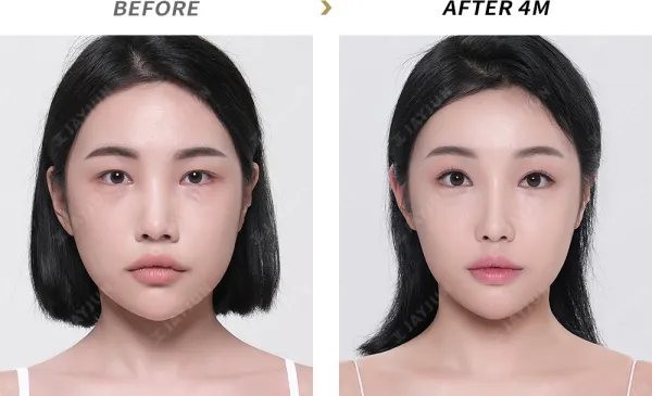 Before/After